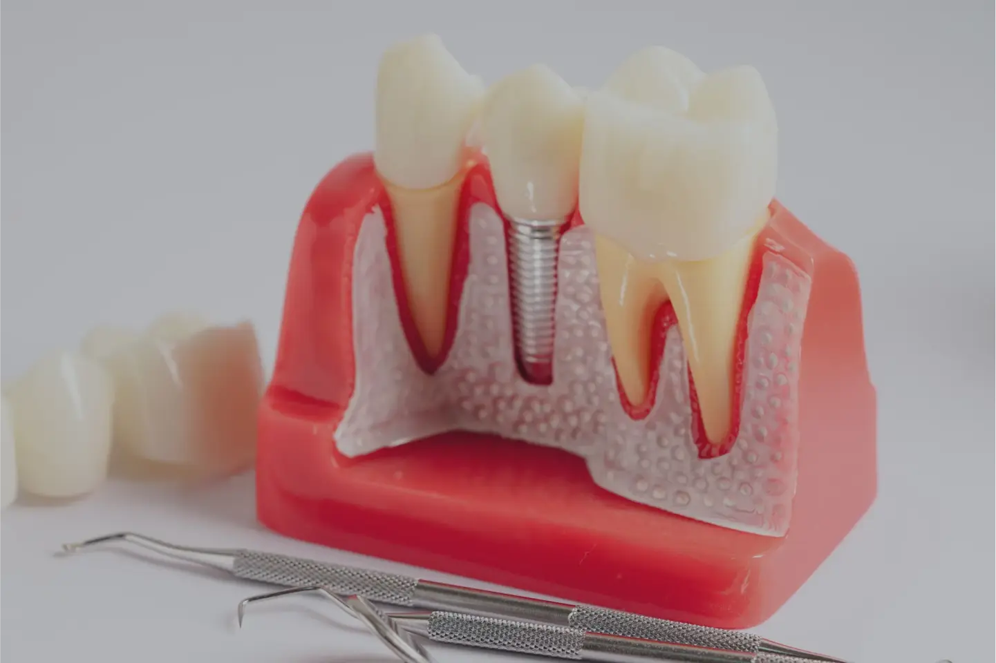 Types of Dental Implants