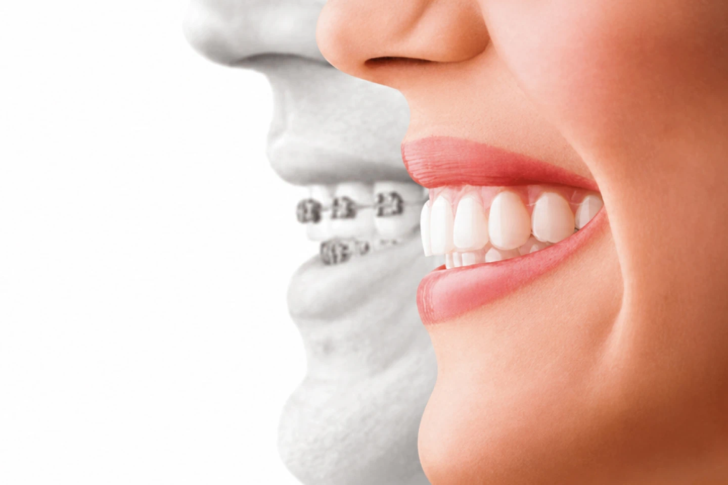 Invisalign vs Braces for Adults