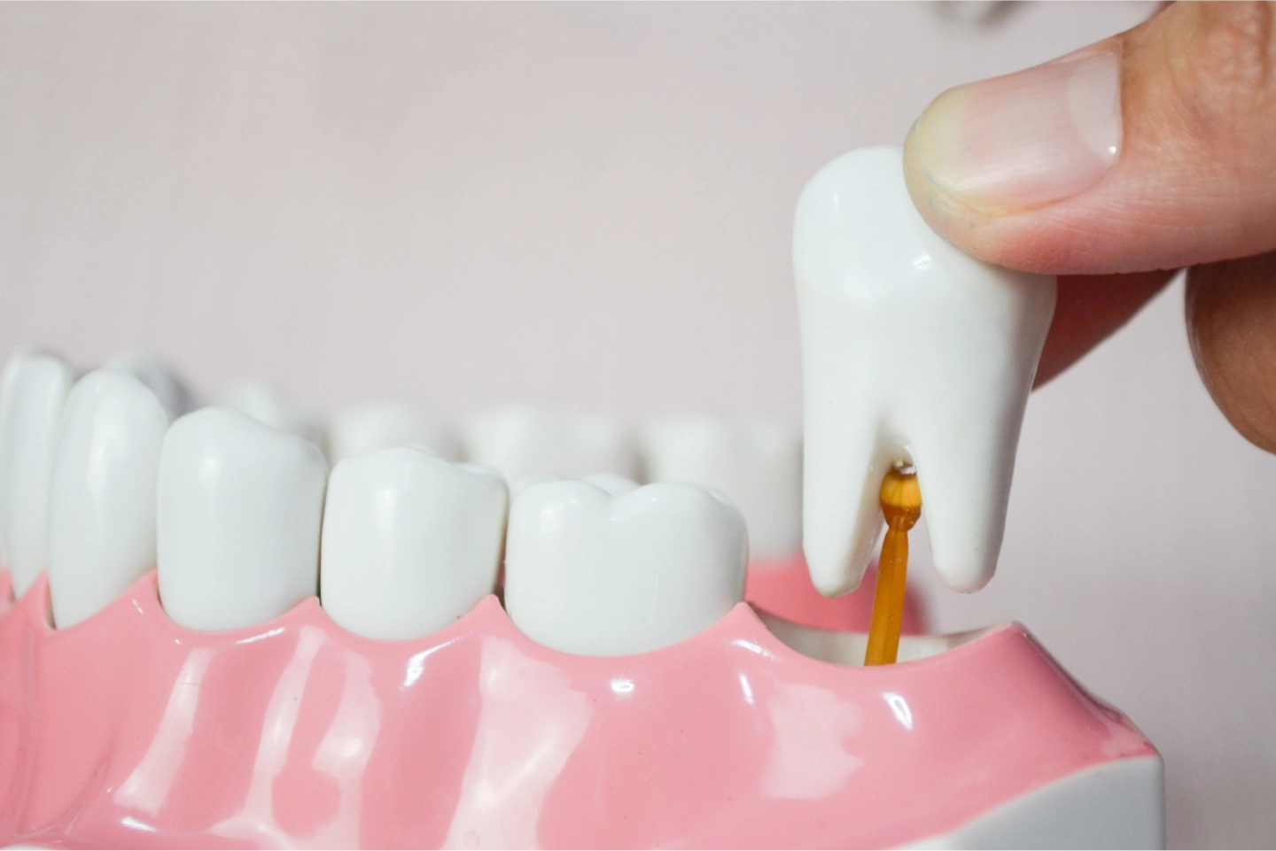 Multiple Teeth Replacement Options - Rockville Family Dental