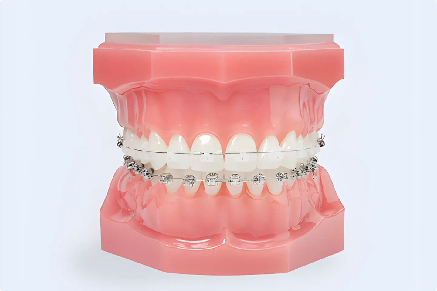 Damon Braces