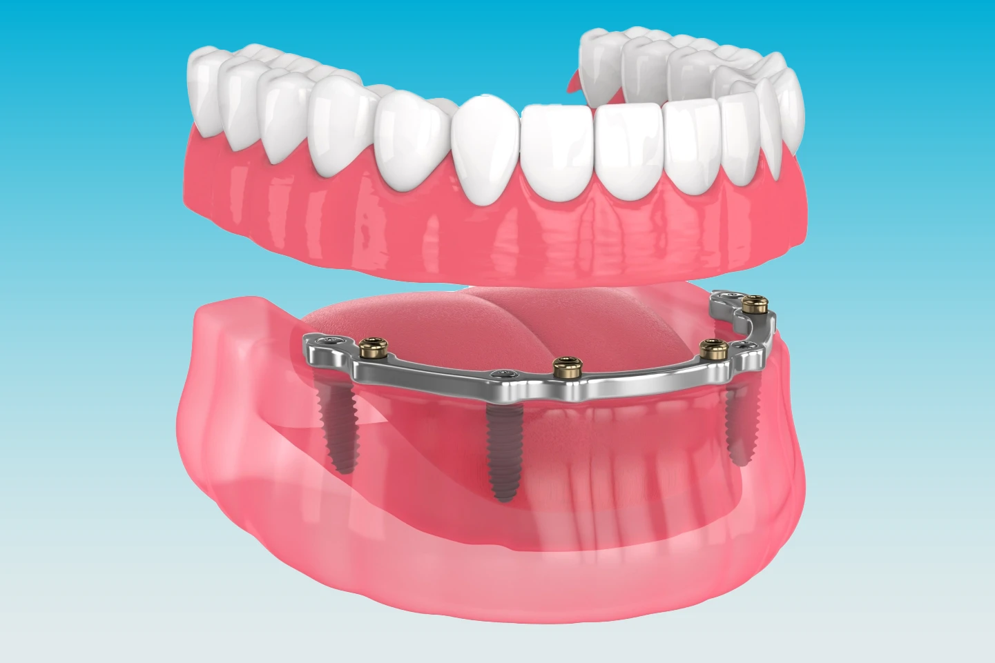 Bar-Supported Dentures image