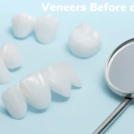 Veneers Before and After