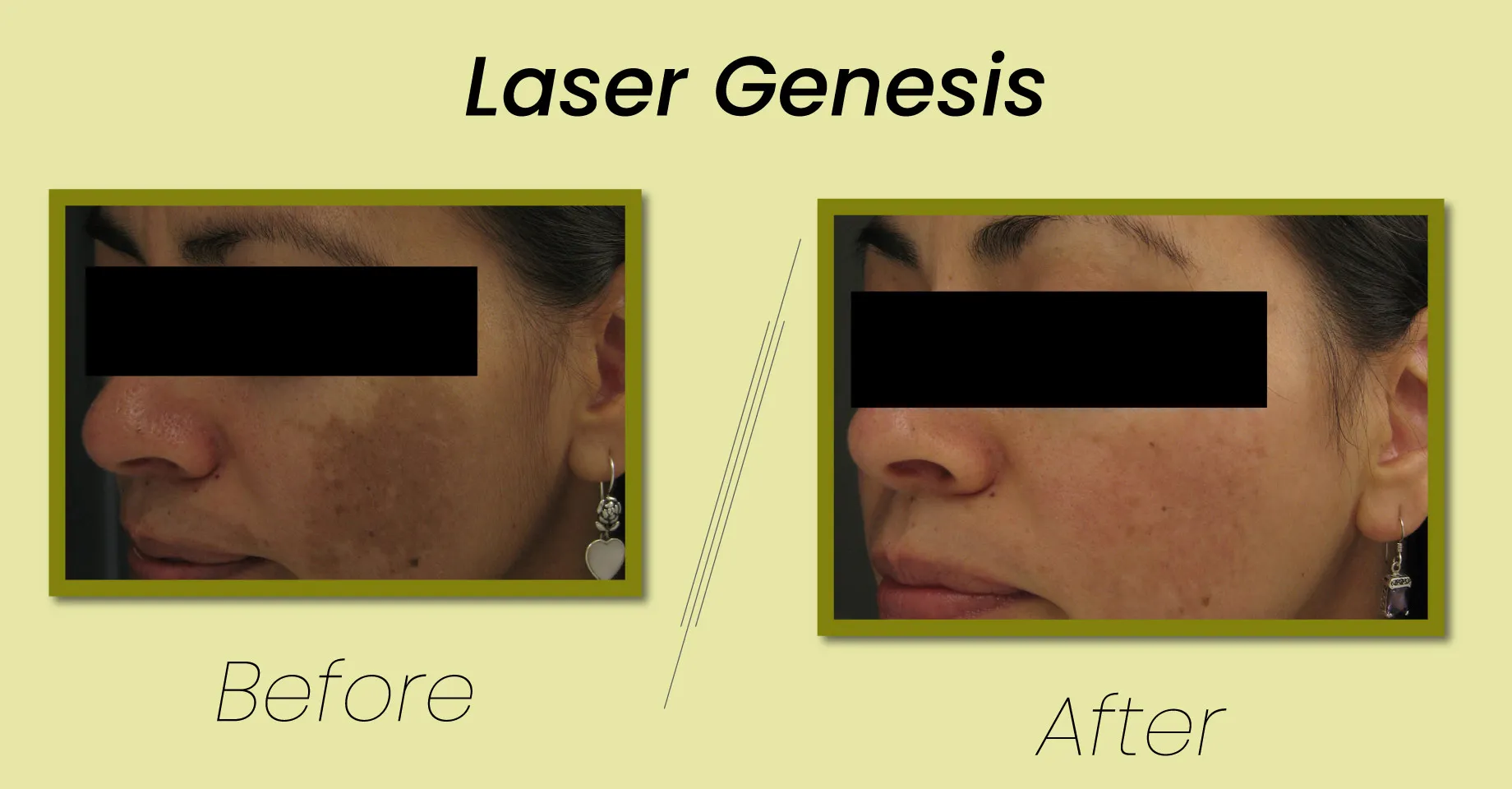 Laser Genesis Treatment | Skin Renewal Treatment with us.