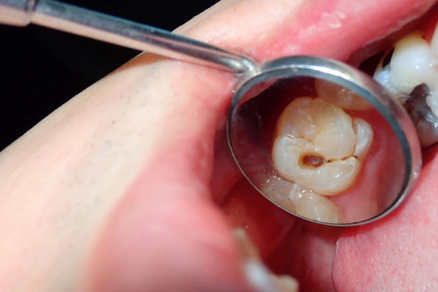 White Fillings  