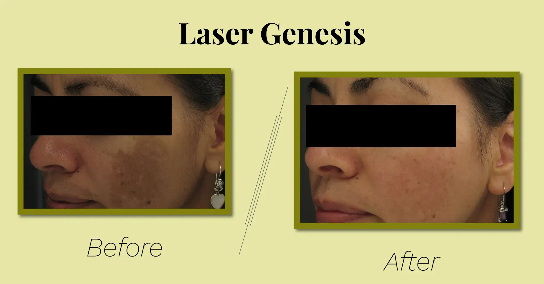 Laser Genesis Treatment | Skin Renewal Treatment with us.