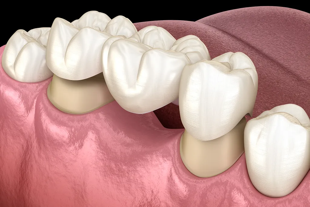 Dental Crowns and Bridges in Tecumseh, ON