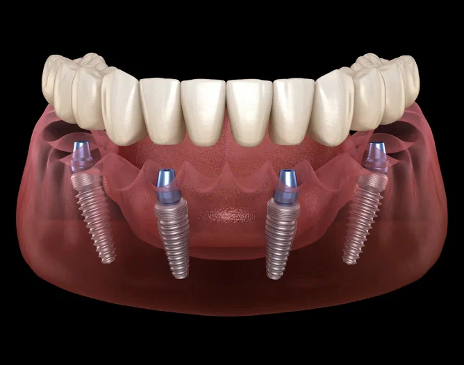 All-on-X Implants