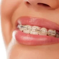 All About Cfast Brace – The Only Guide You Will Need