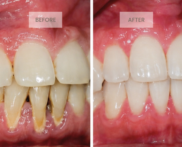 Before After 1
