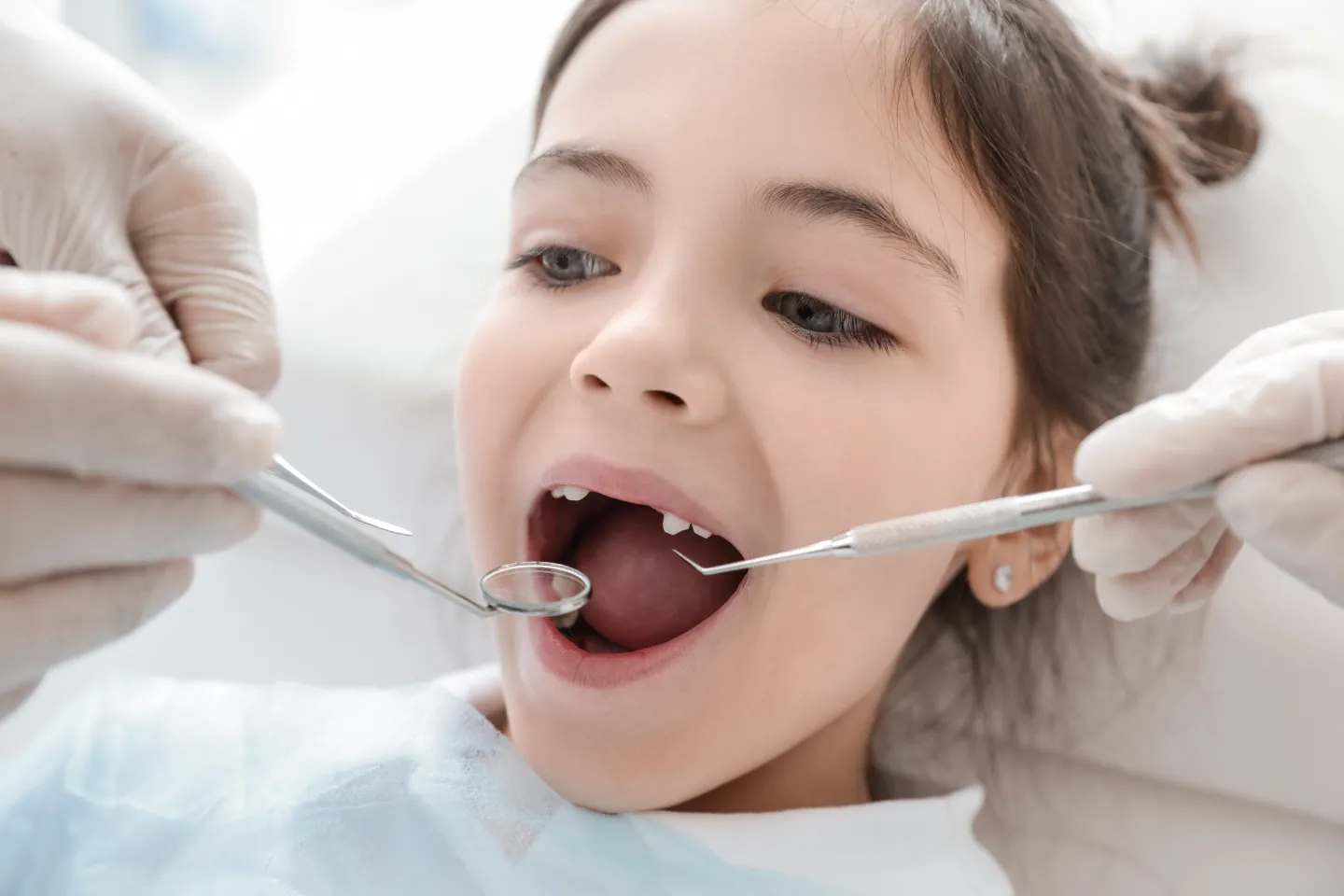 Understanding Dental Sealants