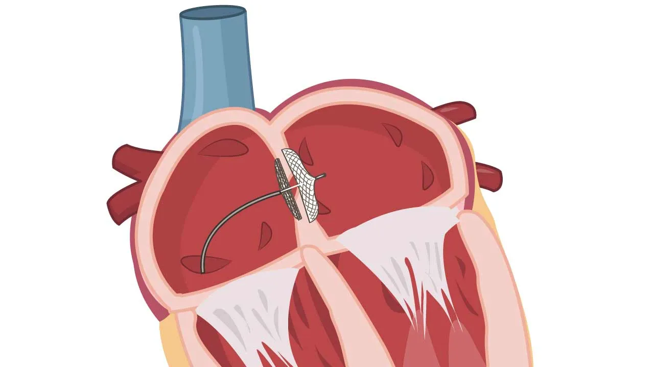 Atrial Fibrillation Explained: Risks, Causes & Care