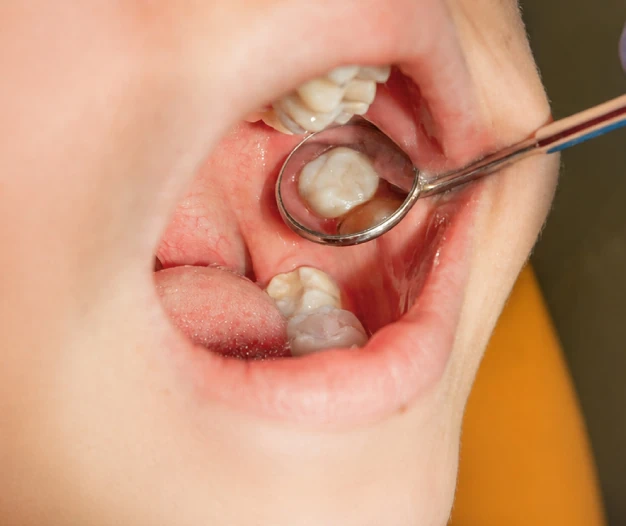 White Fillings