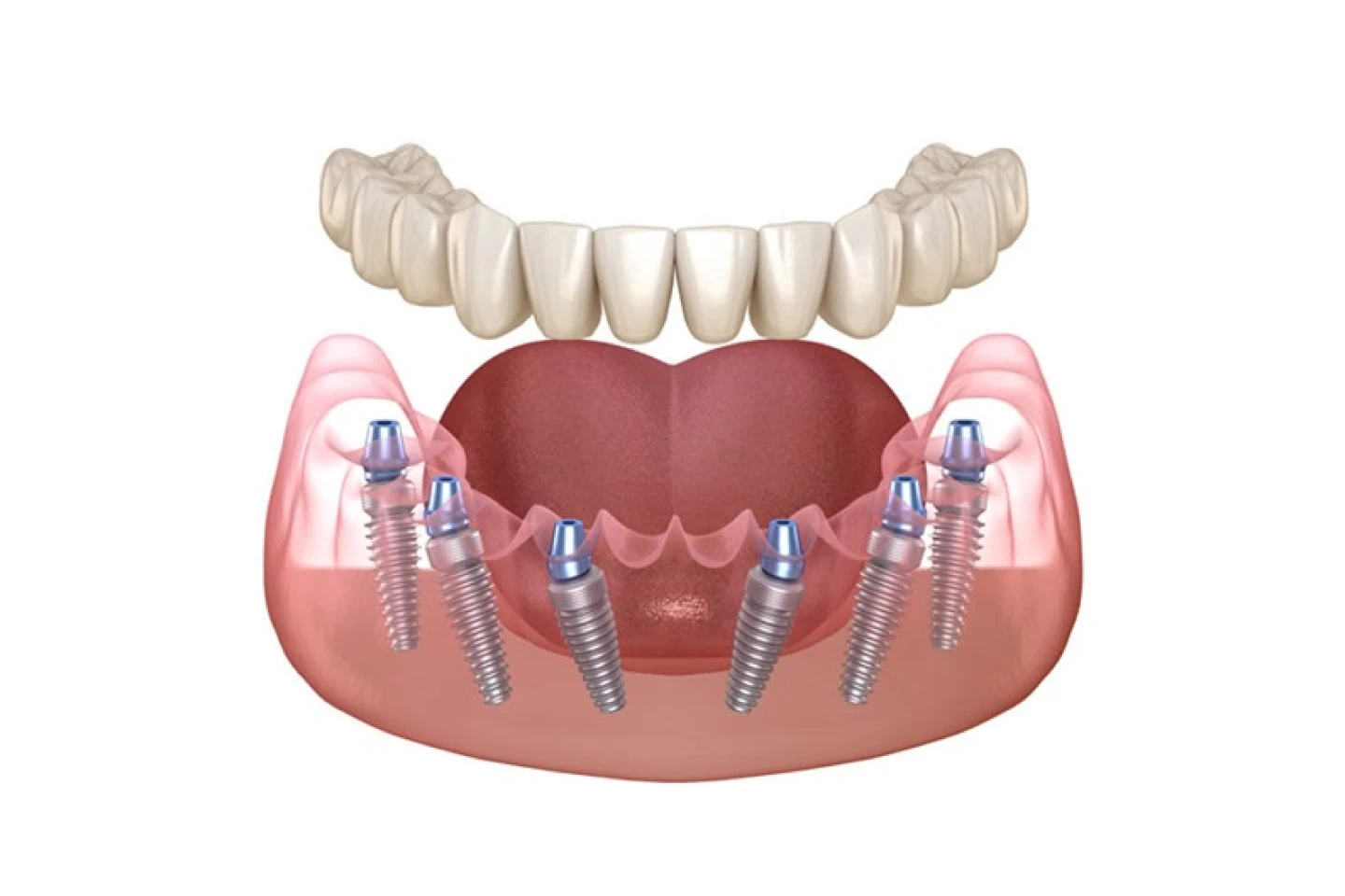 Full Mouth Dental Implant