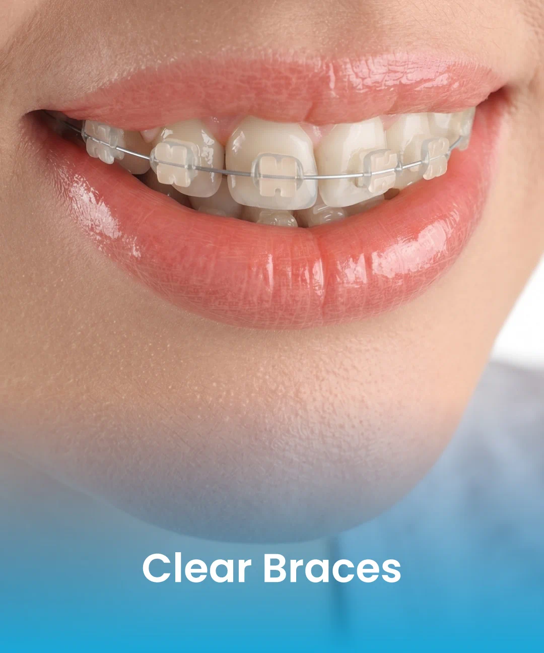 Clear Braces