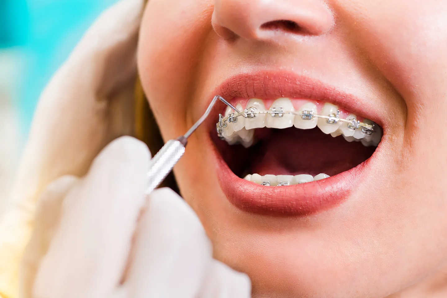 Braces Treatment