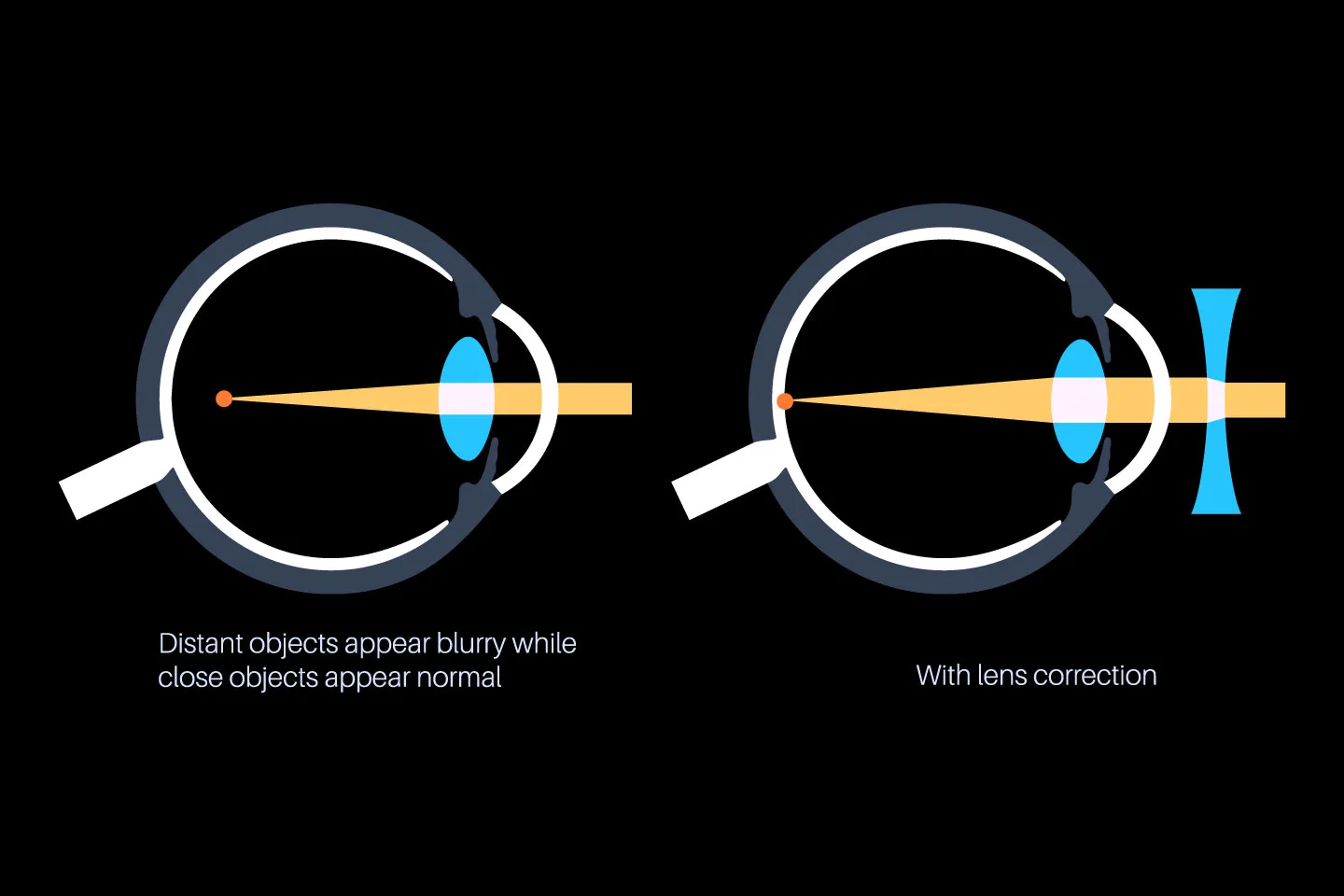 What Methods Are Used in Myopia Correction?