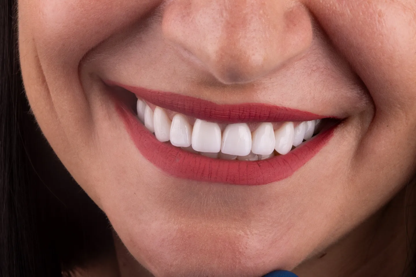 5 Ways To Prepare for Dental Veneers