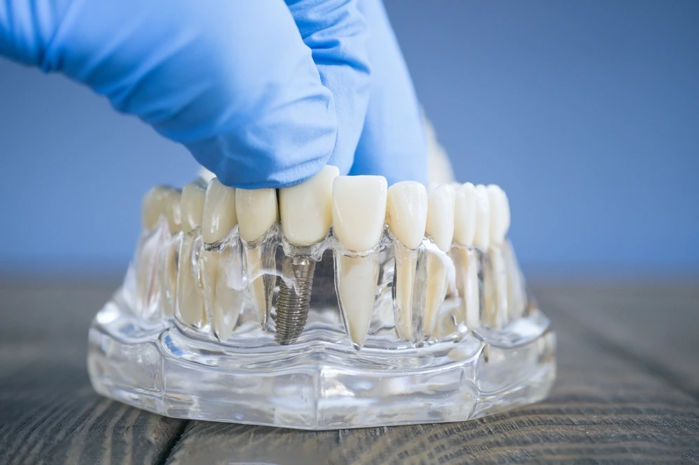 Surgical Placement of Dental Implants in Lawrenceville, GA