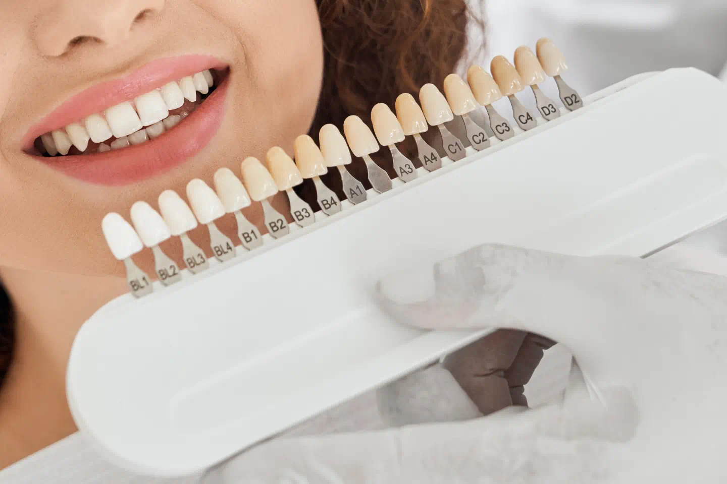 Veneers in Mountain View