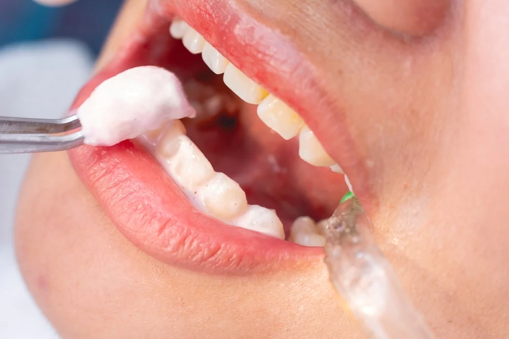 Fluoride