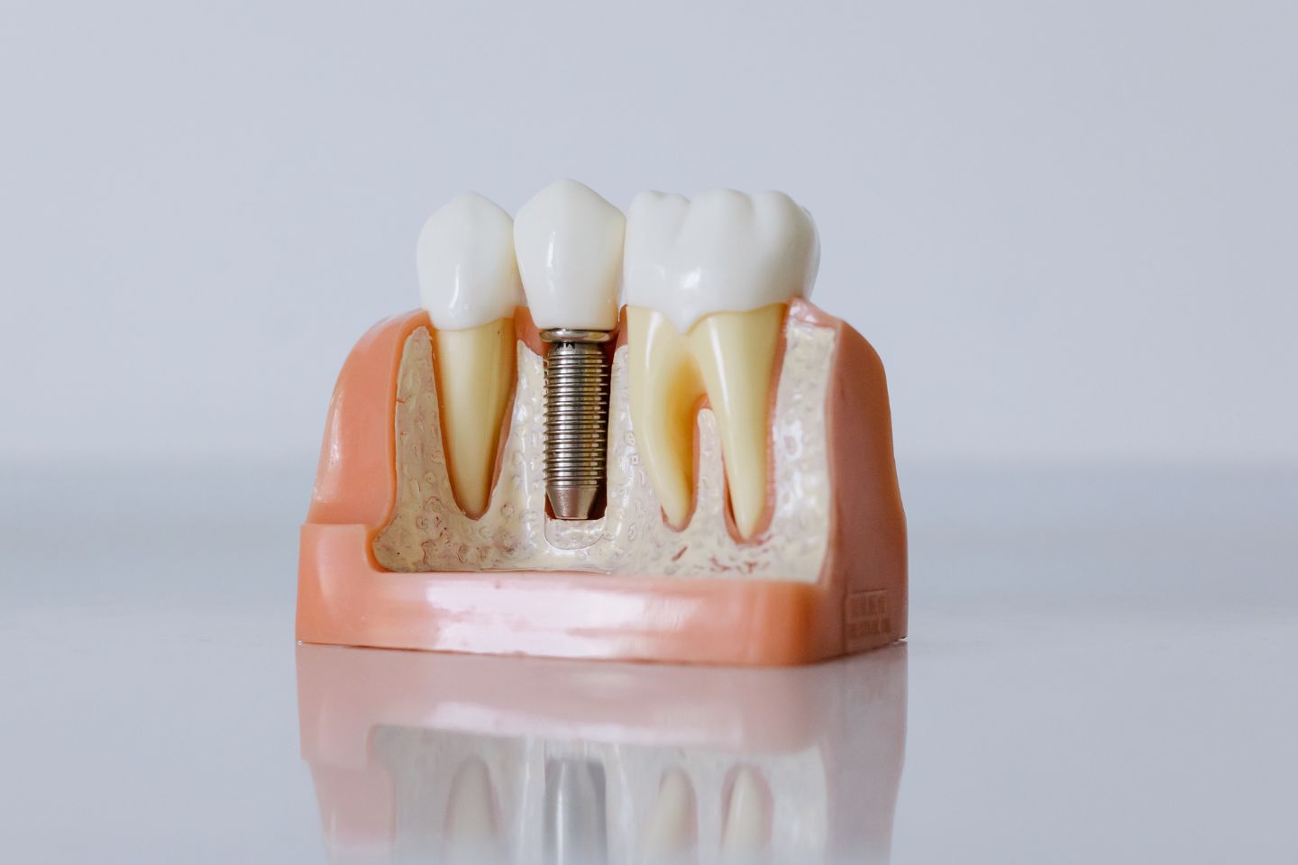 Dental Implants