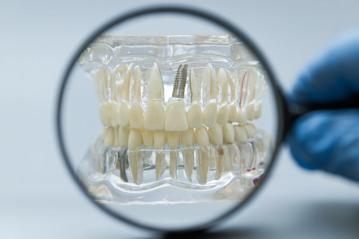 All-on-X Implants in Roselle, IL