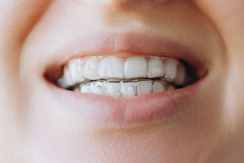 Invisalign   