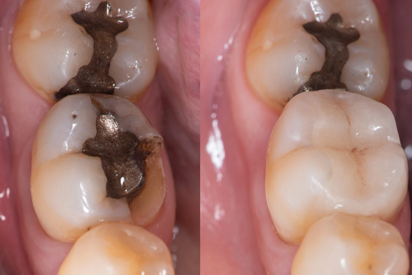 What is Dental Filling & Types of Filling?