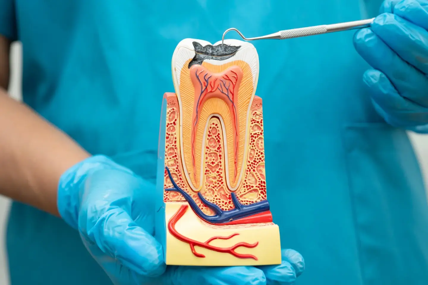 Root Canal Treatment