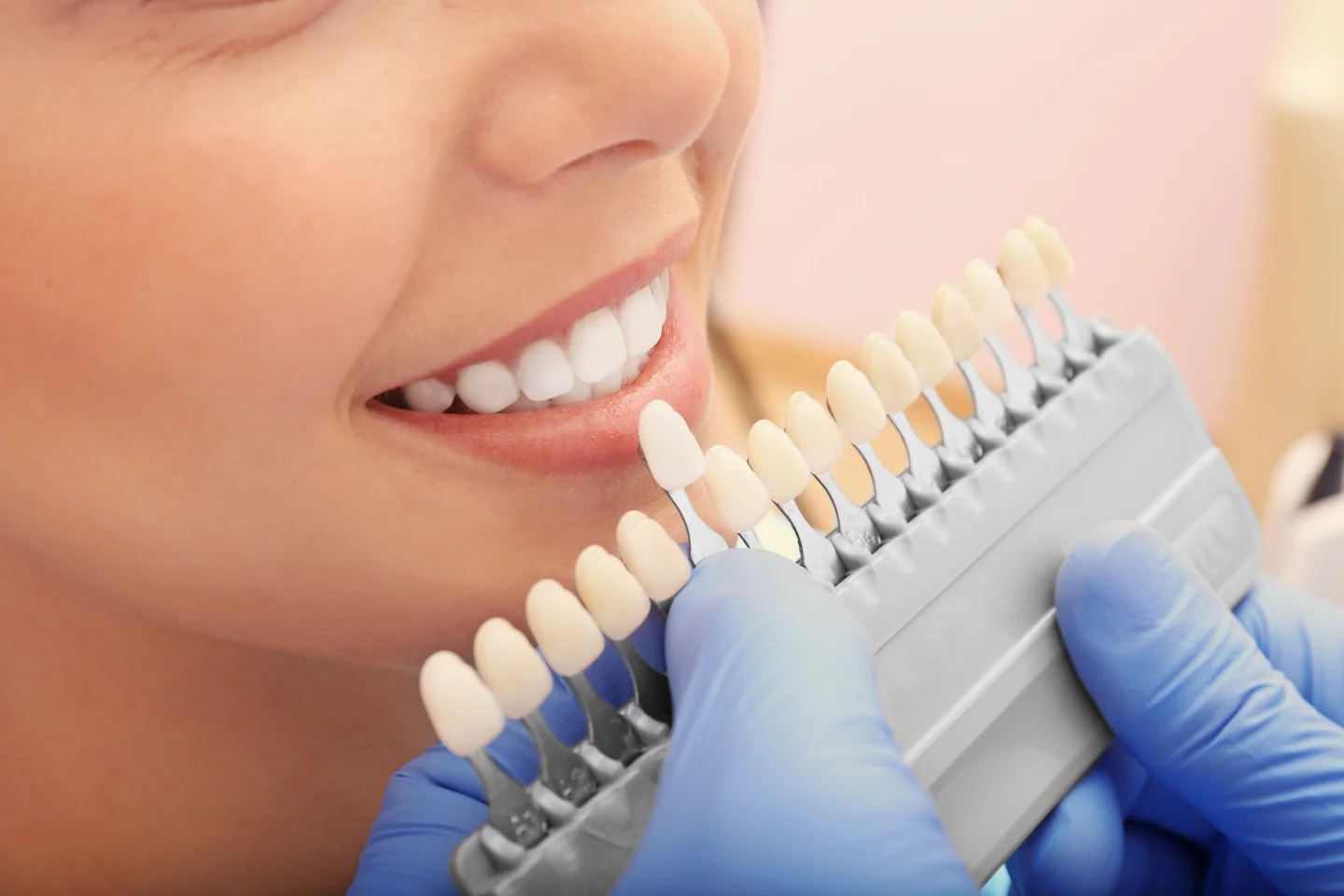 What Happens During a Dental Veneers Procedure