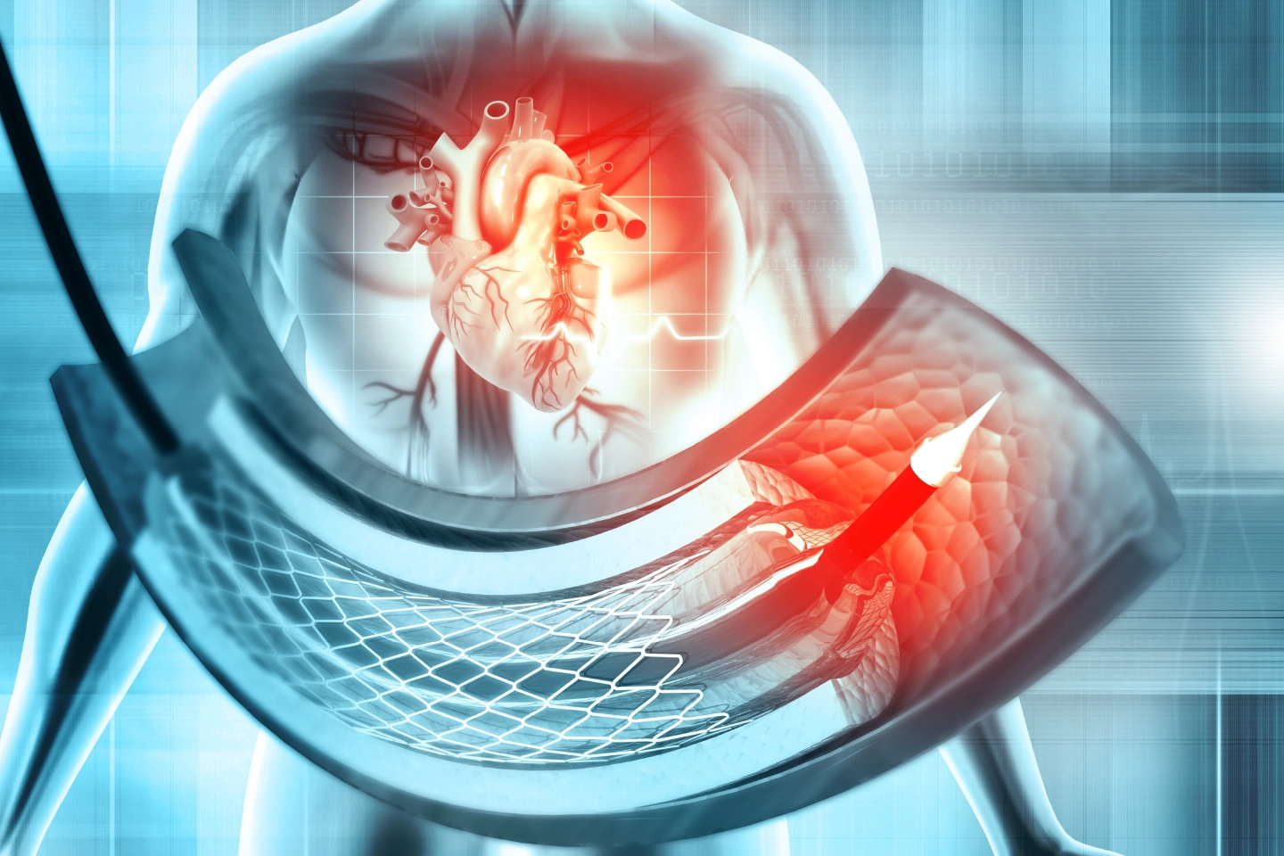 Complex coronary intervention