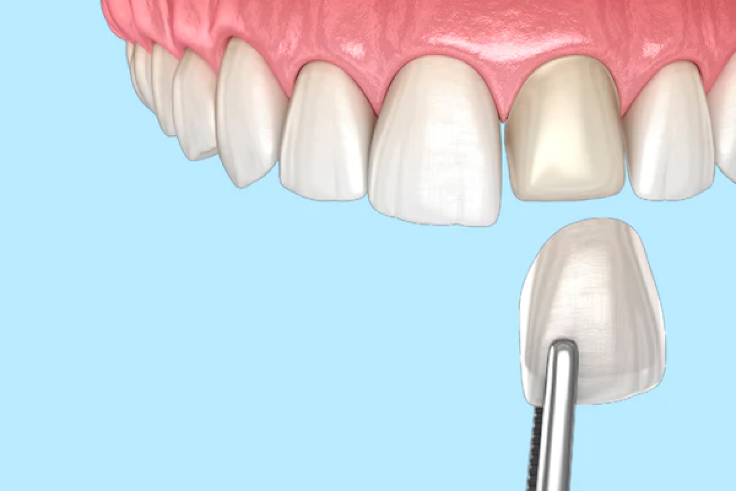 dental veneers