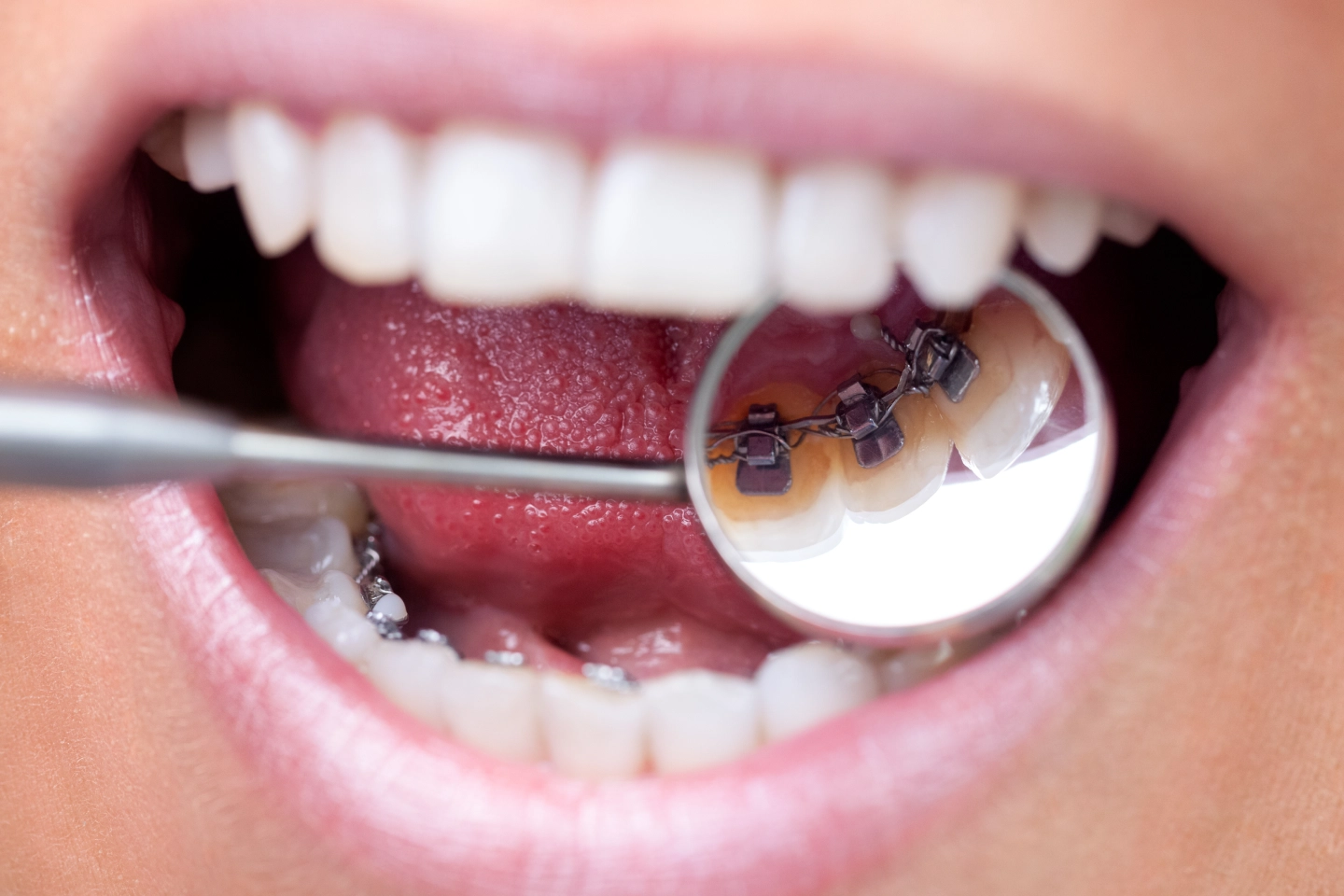 Lingual Braces for Unique Orthodontic Cases | Finesse Dental Care