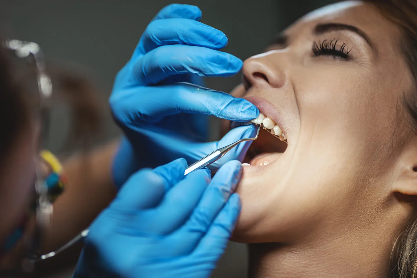 A Guide to Dental bonding