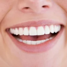 Approximately How Much Does a Full Set of Veneers Cost In Leicester?