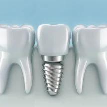 Why Do Dental Implants Cost So Much And Are They Worth It?