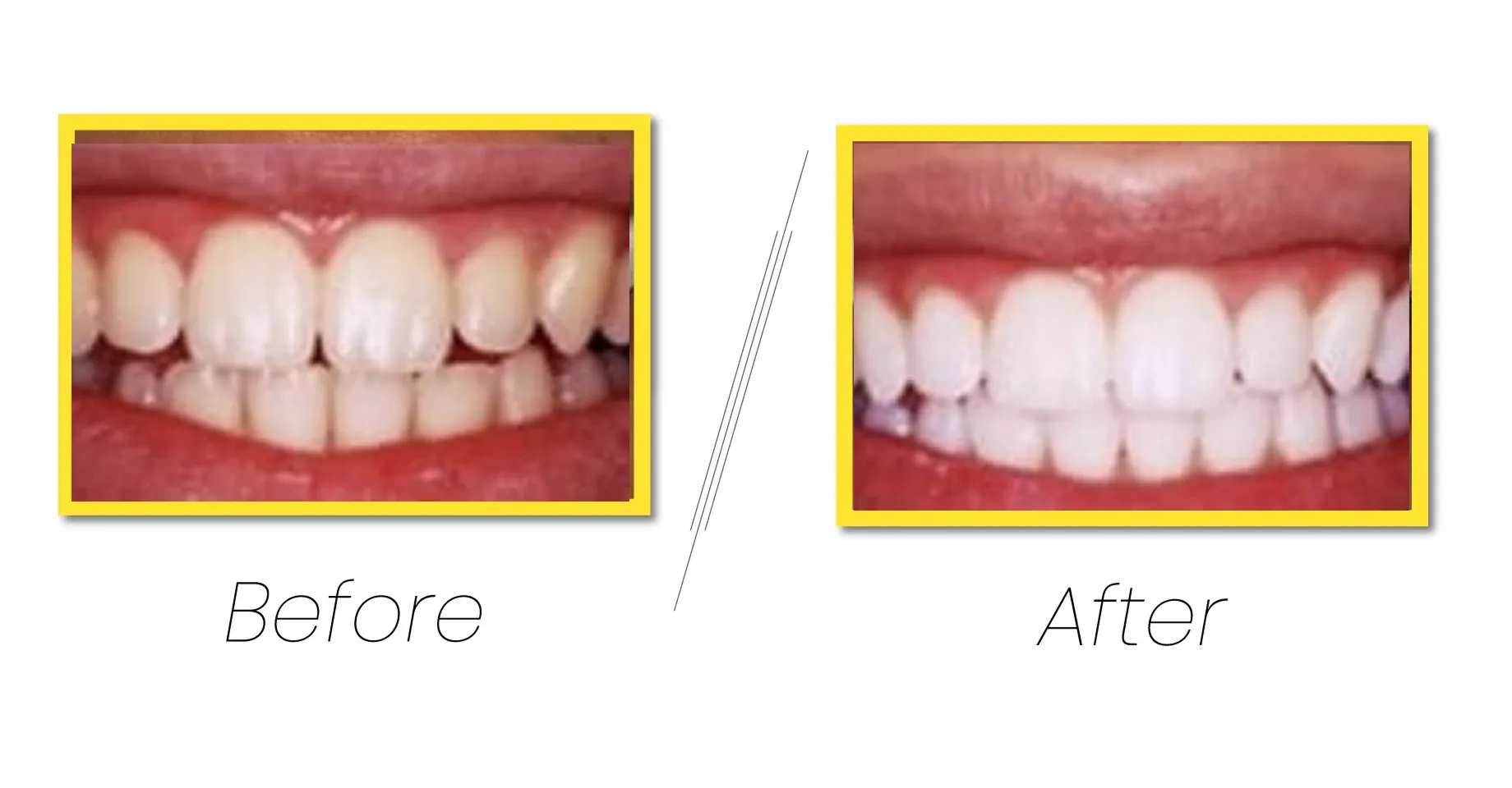 Dental Veneers transform smiles with thin porcelain shells