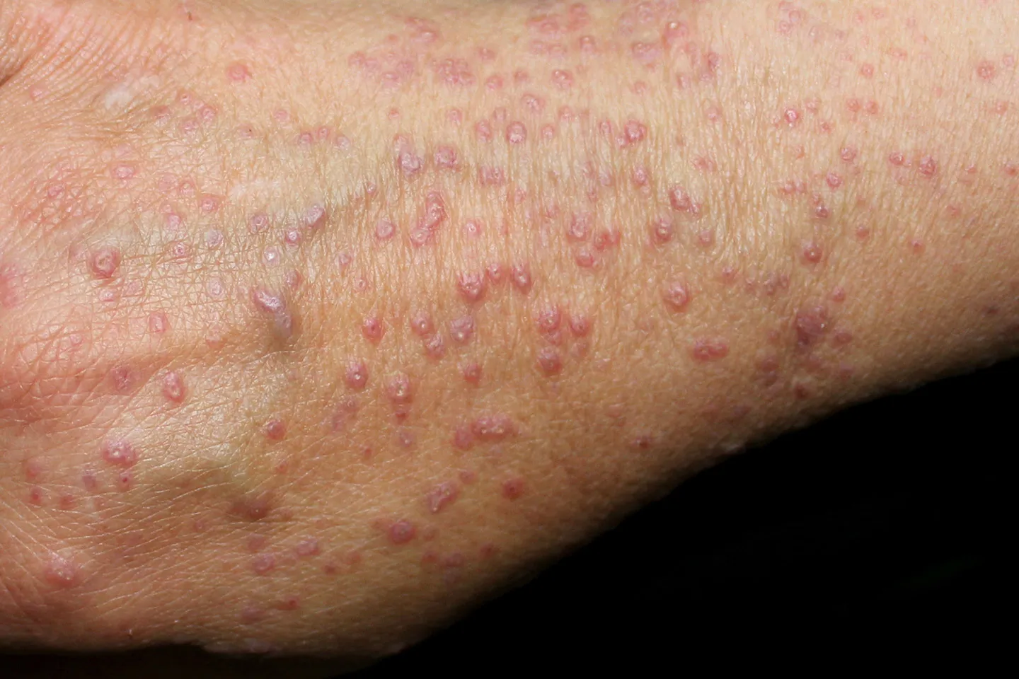 Close up of a person's hand with red spots on it suffer from lichen planus