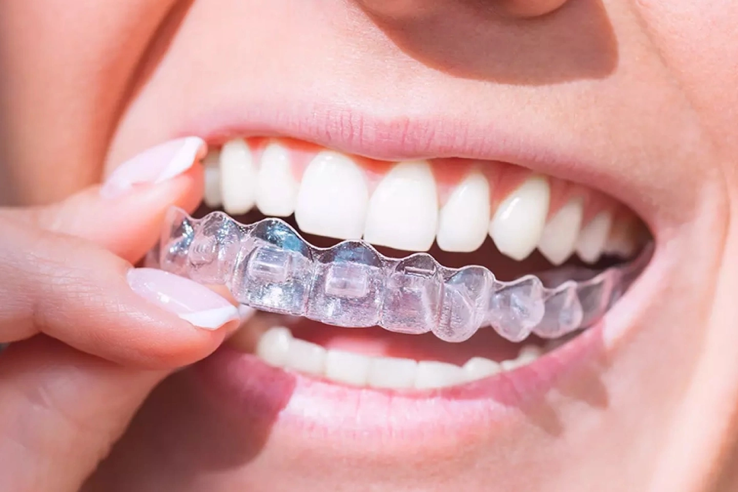 Do Braces Permanently Fix Crooked Teeth