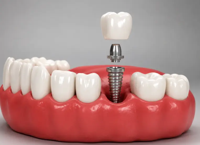 Single tooth implant