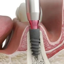 What Happens If a Dental Implant Fails? (And How We Prevent It at Natural Smiles)