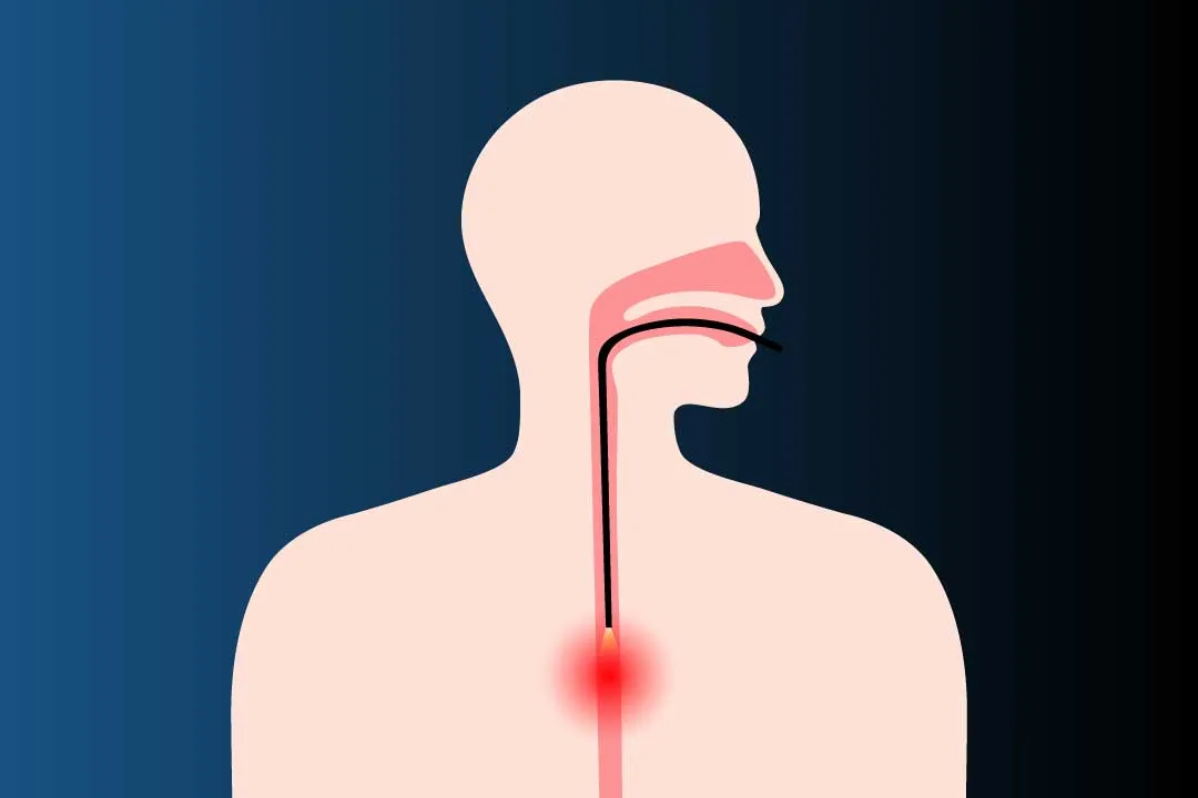 Esophageal Surgery