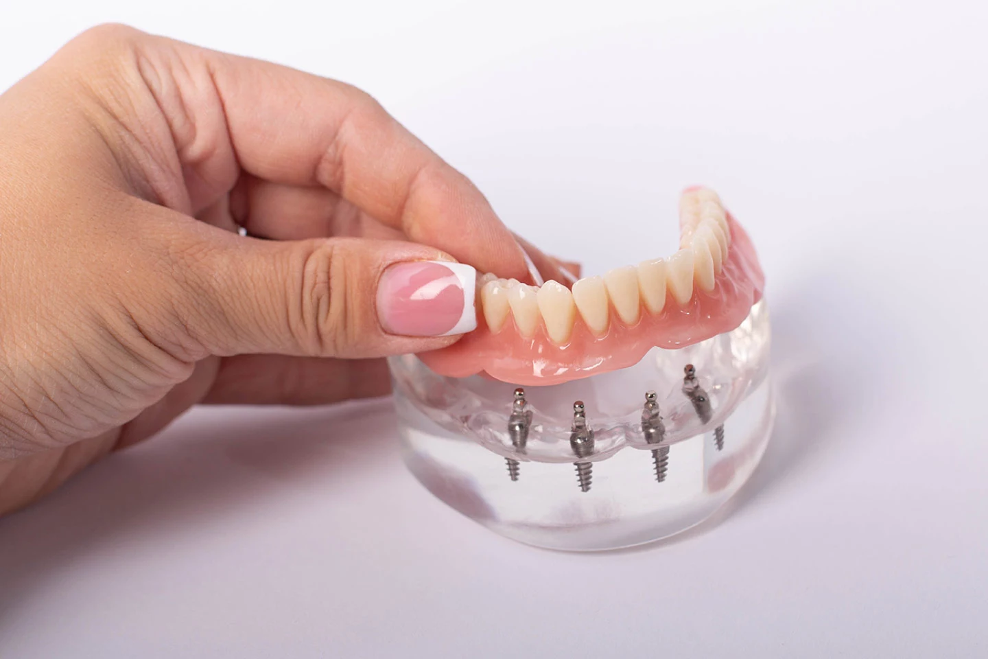 All-on-4 Implants - Rockville Family Dental