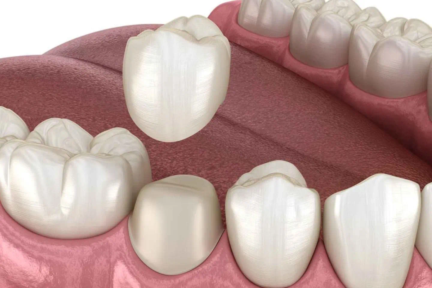 dental crown materials