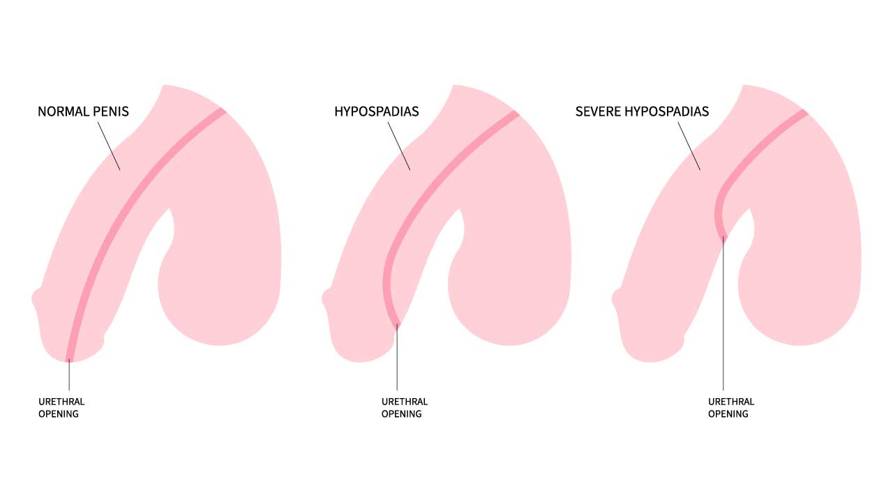 Hypospadias- A Common Birth Condition Every Parent Should Understand