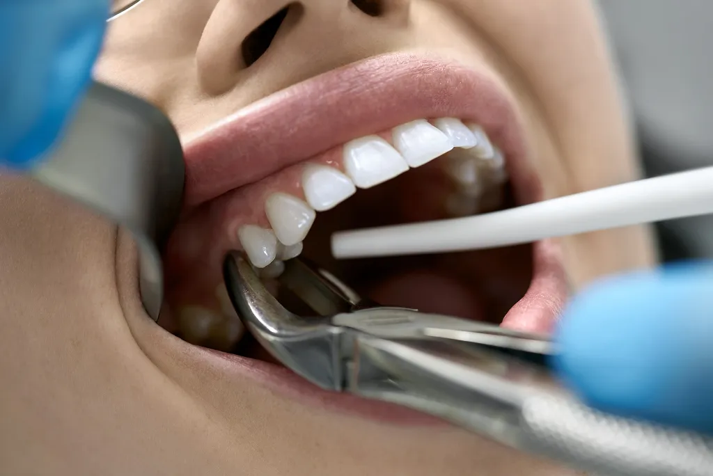 Tooth Extractions | Gentle Tooth Removal