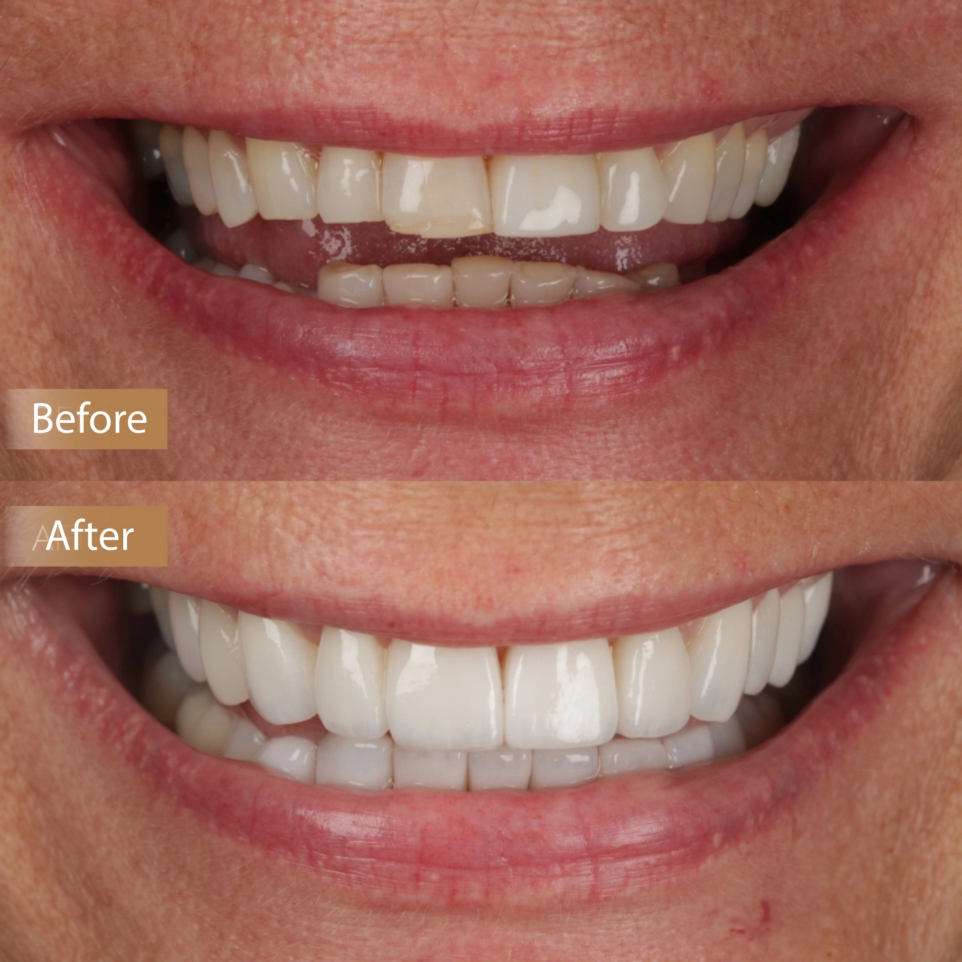 Porcelain Veneers image