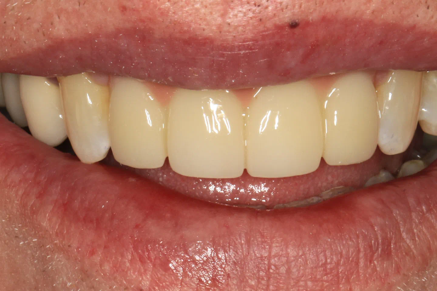 After cosmetic implant treatment