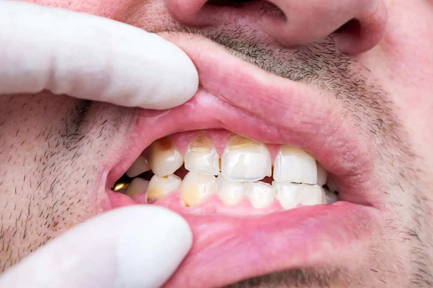 Can a Dentist Restore Tooth Enamel? Facts & Options | Manteca Smiles