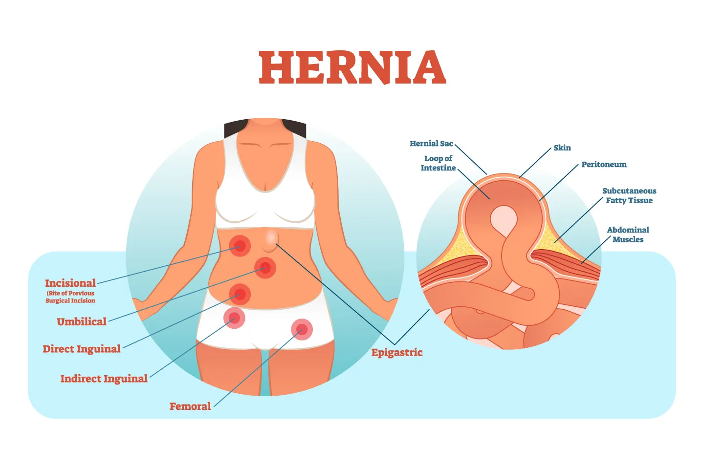 Different Types of Hernias: Inguinal, Umbilical, Hiatal & More